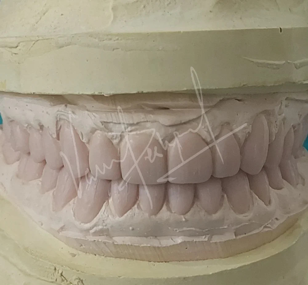 Full Mouth Rehabilitation with Metal Ceramic Prosthesis - Image 5