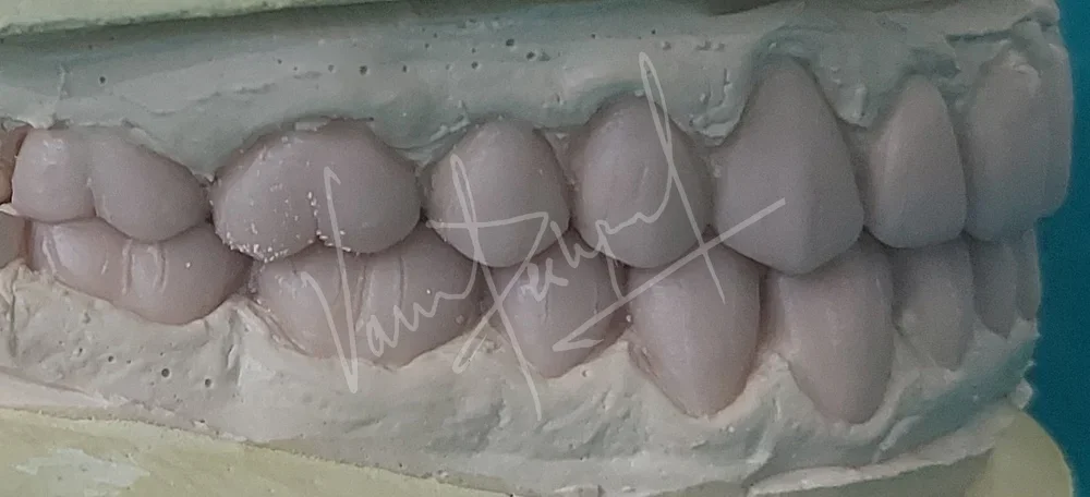 Full Mouth Rehabilitation with Metal Ceramic Prosthesis - Image 6