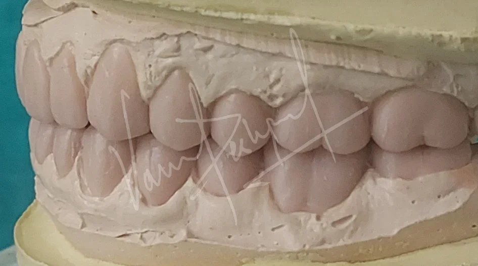 Full Mouth Rehabilitation with Metal Ceramic Prosthesis - Image 7