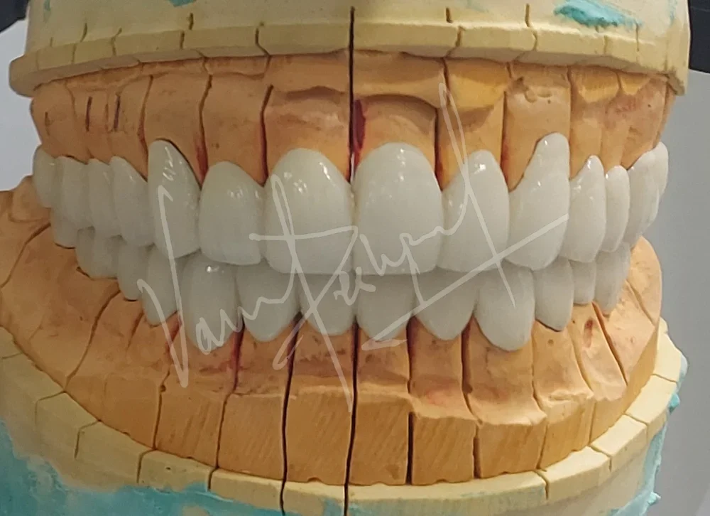 Full Mouth Rehabilitation with Metal Ceramic Prosthesis - Image 8
