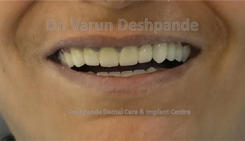 Full Mouth Rehabilitation with Metal Ceramic Prosthesis