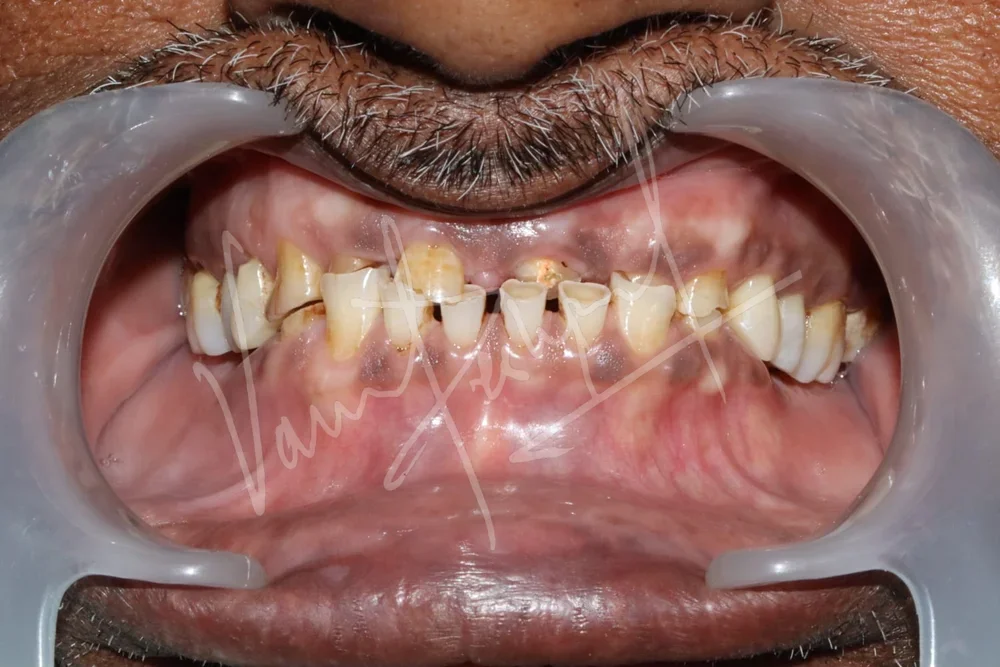 Full Mouth Rehabilitation with Metal Ceramic Restoration and Dental Implants - Image 1