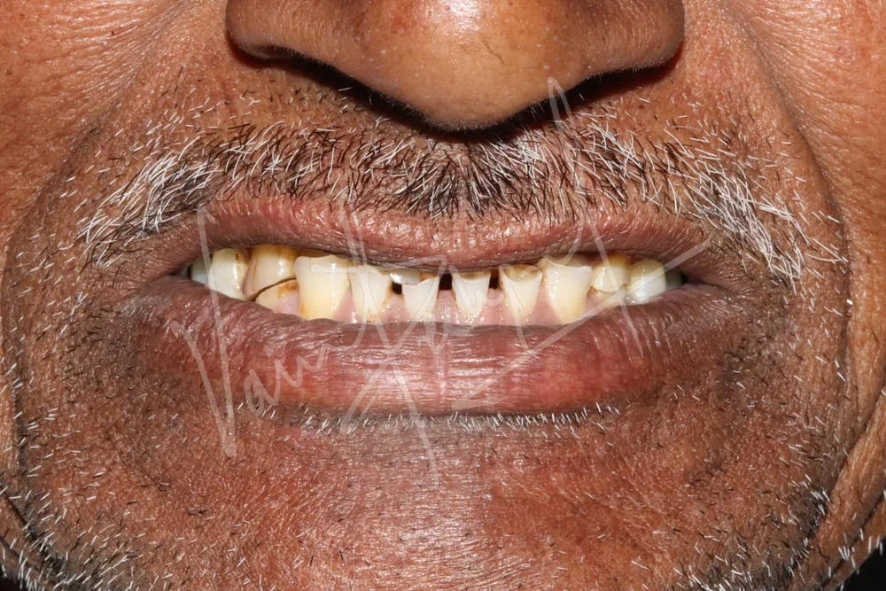 Full Mouth Rehabilitation with Metal Ceramic Restoration and Dental Implants - Image 3