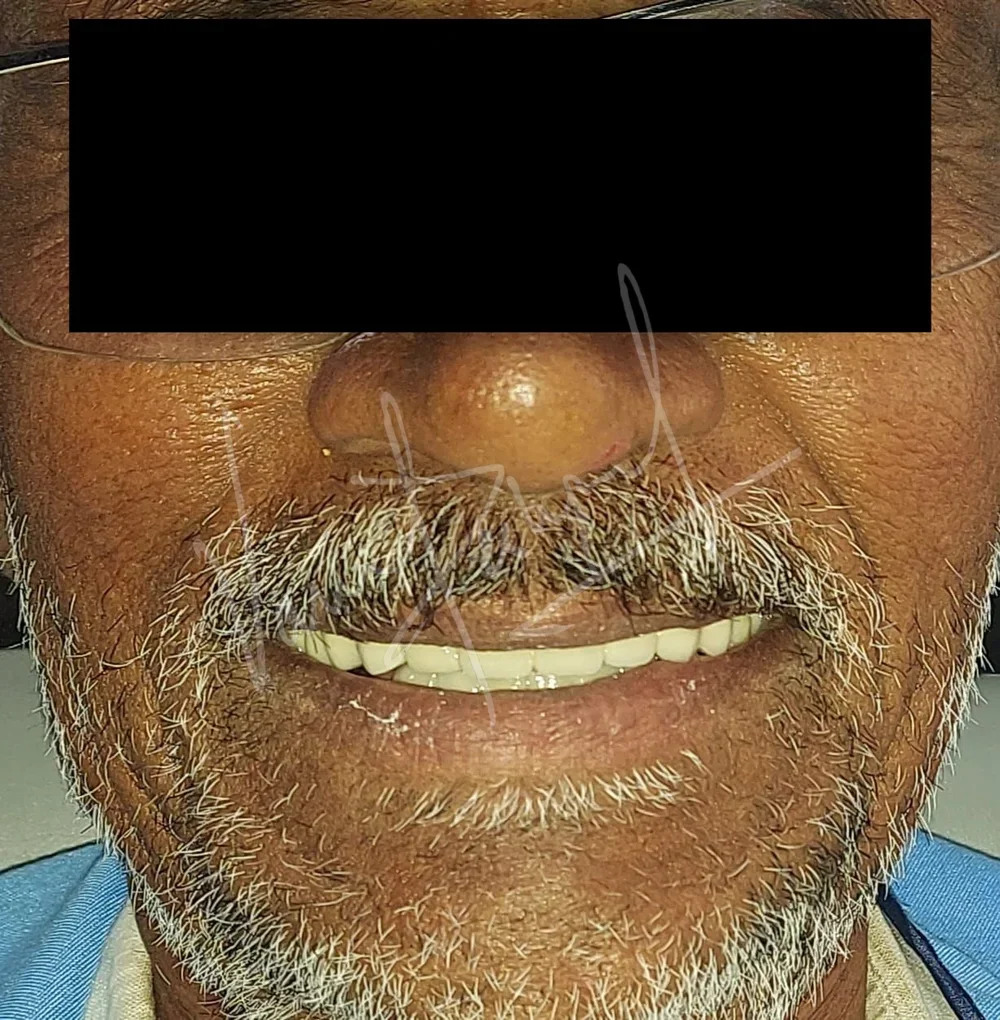 Full Mouth Rehabilitation with Metal Ceramic Restoration and Dental Implants - Image 4