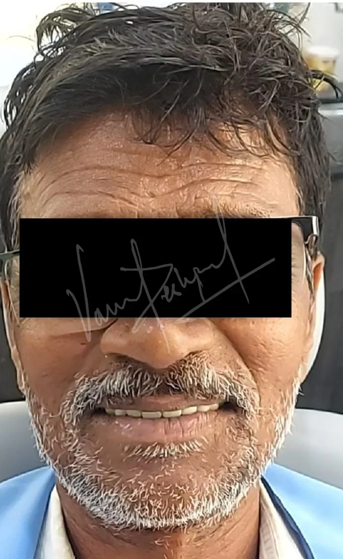 Full Mouth Rehabilitation with Metal Ceramic Restoration and Dental Implants