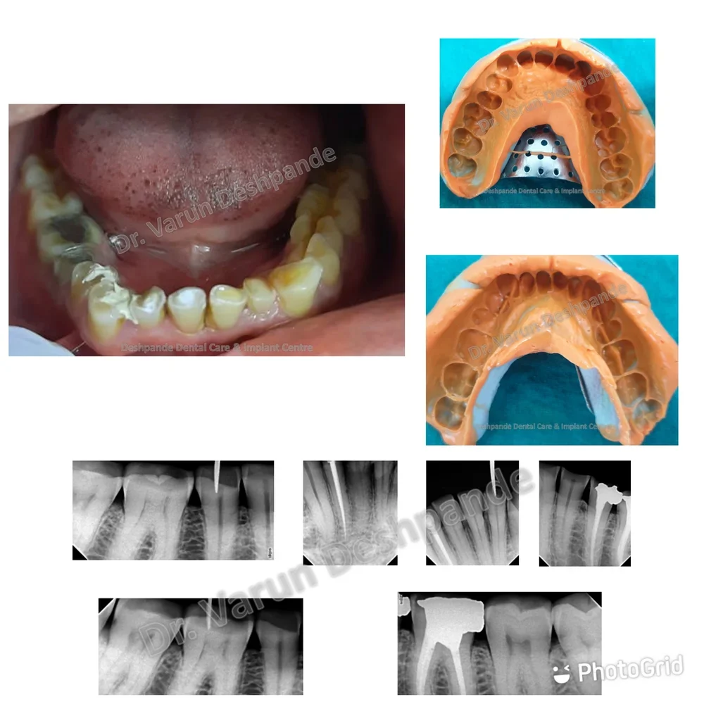 Lower Arch Reconstruction with Zirconia Prosthesis - Image 1