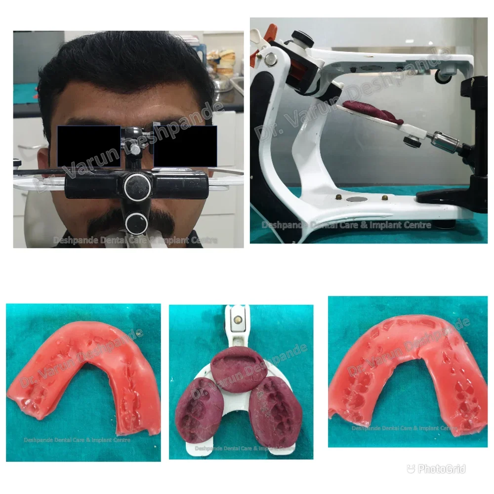 Lower Arch Reconstruction with Zirconia Prosthesis - Image 2