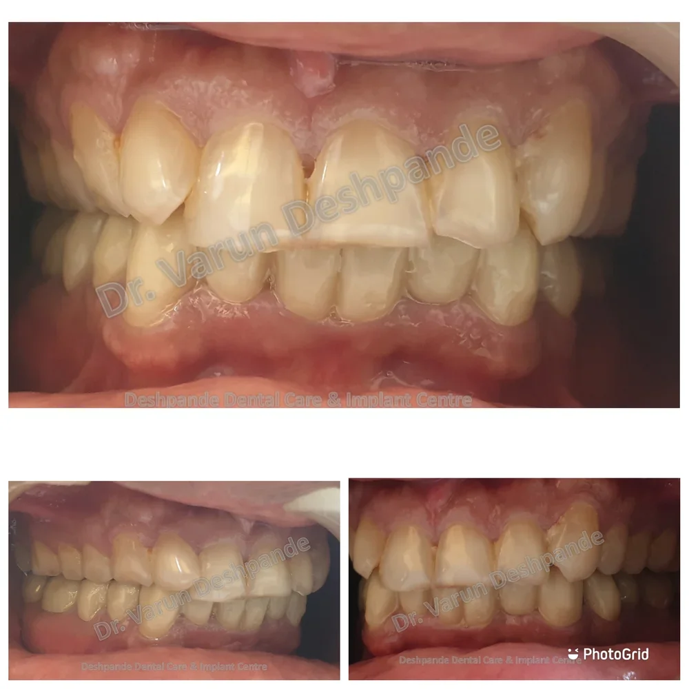 Lower Arch Reconstruction with Zirconia Prosthesis - Image 7