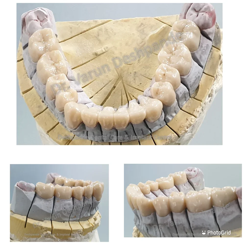 Lower Arch Reconstruction with Zirconia Prosthesis