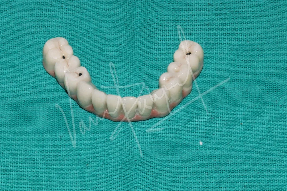 Mandibular Fixed Prosthesis using Dental Implants
