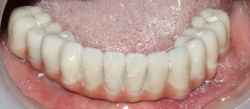 Mandibular Fixed Prosthesis using Dental Implants SB - Image 3