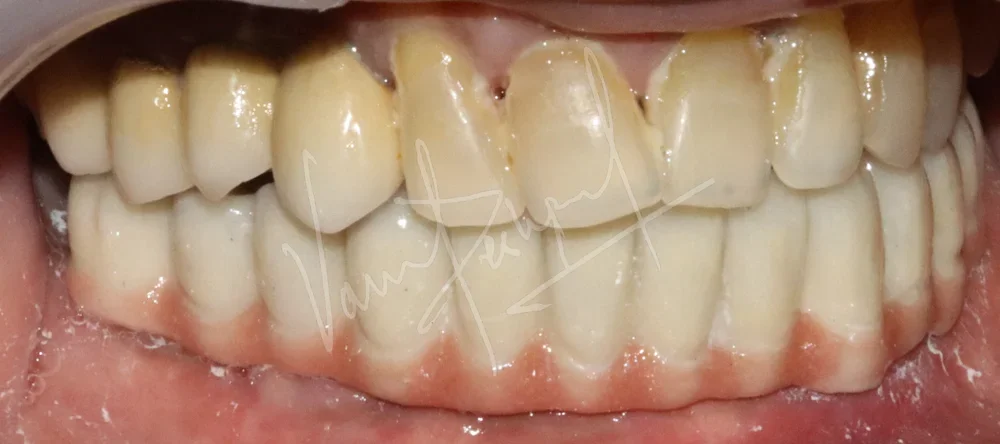 Mandibular Fixed Prosthesis using Dental Implants SB - Image 4