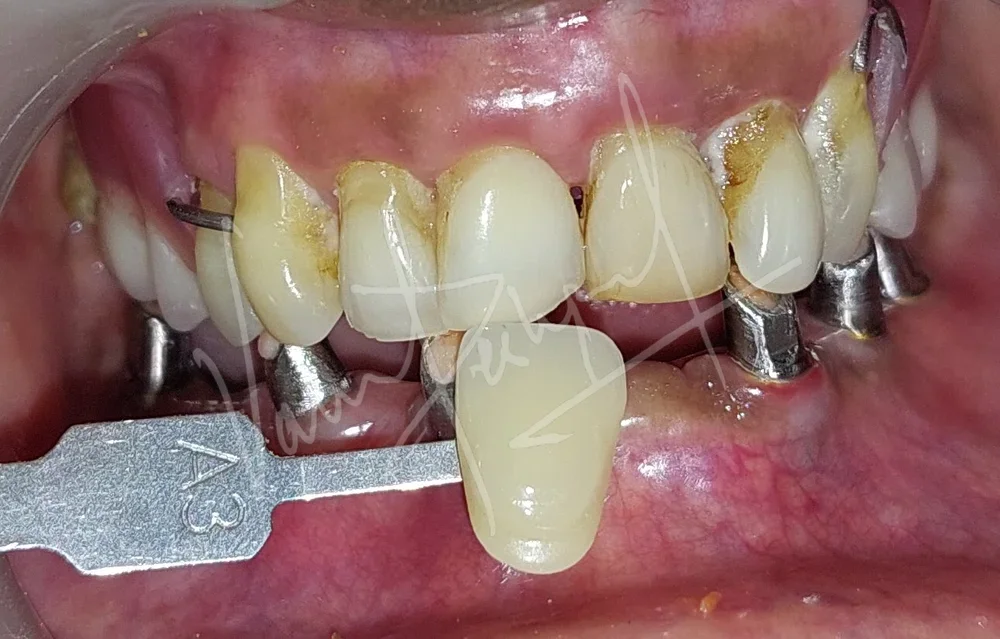 Mandibular Implant supported Fixed Prosthesis