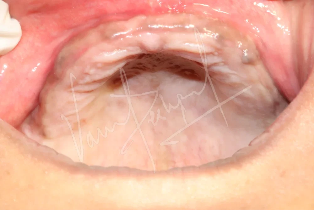 Maxillary and Mandibular All on 4 Implant Supported Prosthesis - Image 4