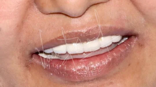 Maxillary and Mandibular All on 4 Implant Supported Prosthesis