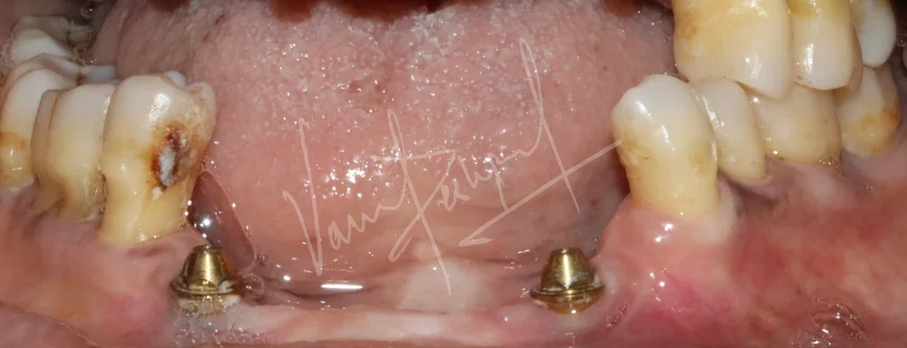 Maxillary and Mandibular Implant supported Fixed Prosthesis - Image 3