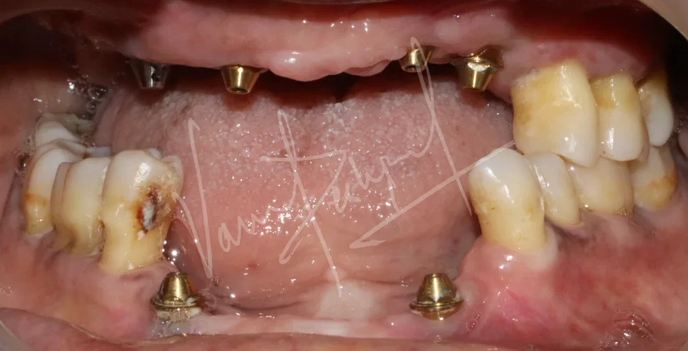 Maxillary and Mandibular Implant supported Fixed Prosthesis - Image 4