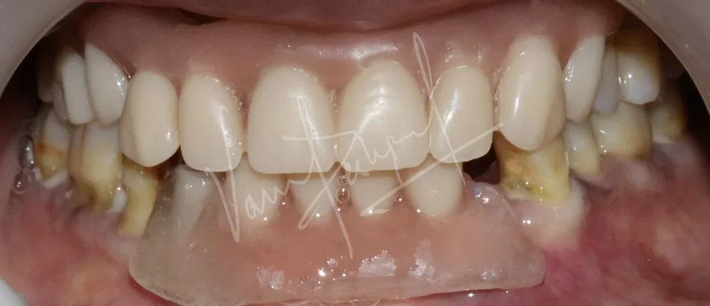 Maxillary and Mandibular Implant supported Fixed Prosthesis - Image 5