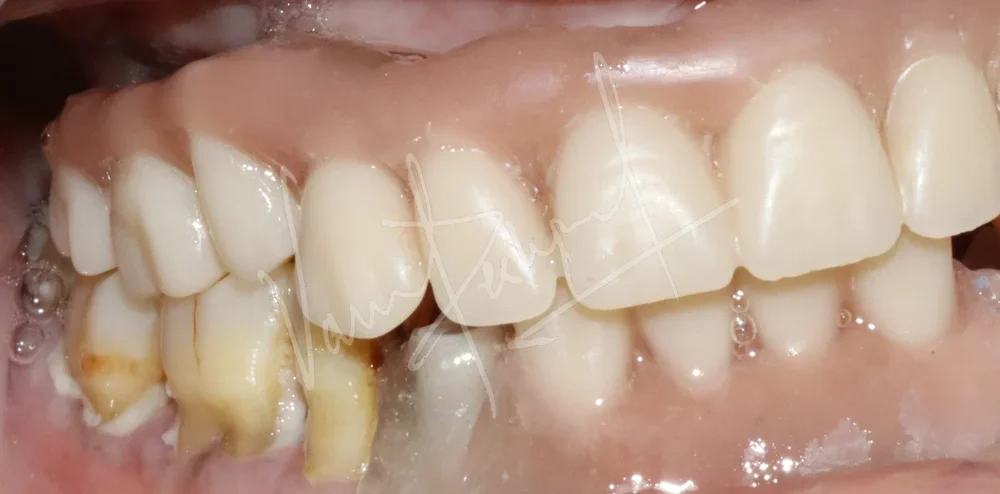 Maxillary and Mandibular Implant supported Fixed Prosthesis - Image 6