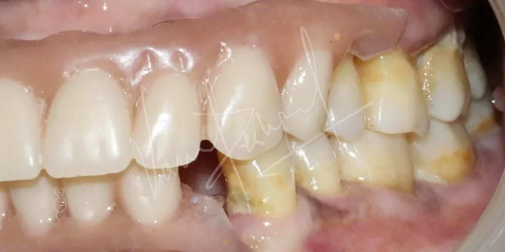 Maxillary and Mandibular Implant supported Fixed Prosthesis - Image 7