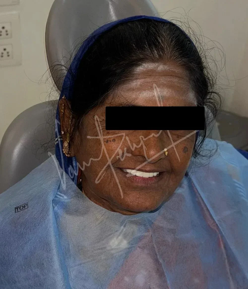 Maxillary and Mandibular Implant supported Fixed Prosthesis