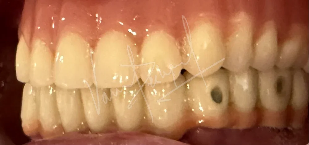 Maxillary Complete Denture and Mandibular Implant supported Fixed Prosthesis - Image 5