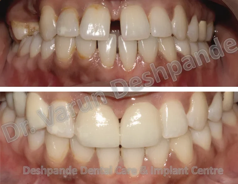 Dental Veneers
