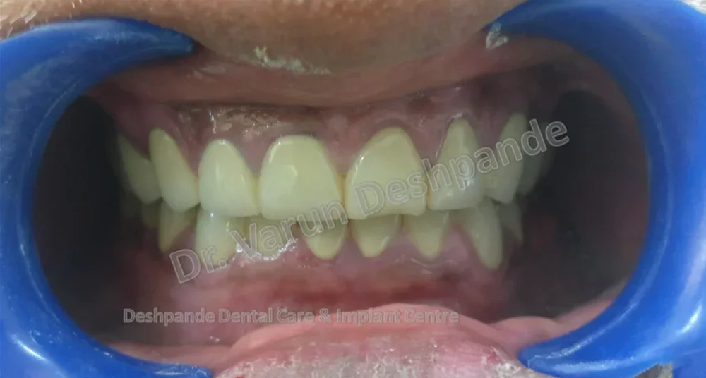 One Year Follow up of FMR case with Metal Ceramic Prosthesis