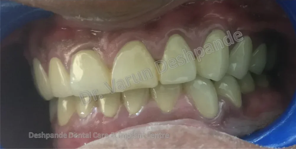 One Year Follow up of FMR case with Metal Ceramic Prosthesis - Image 3