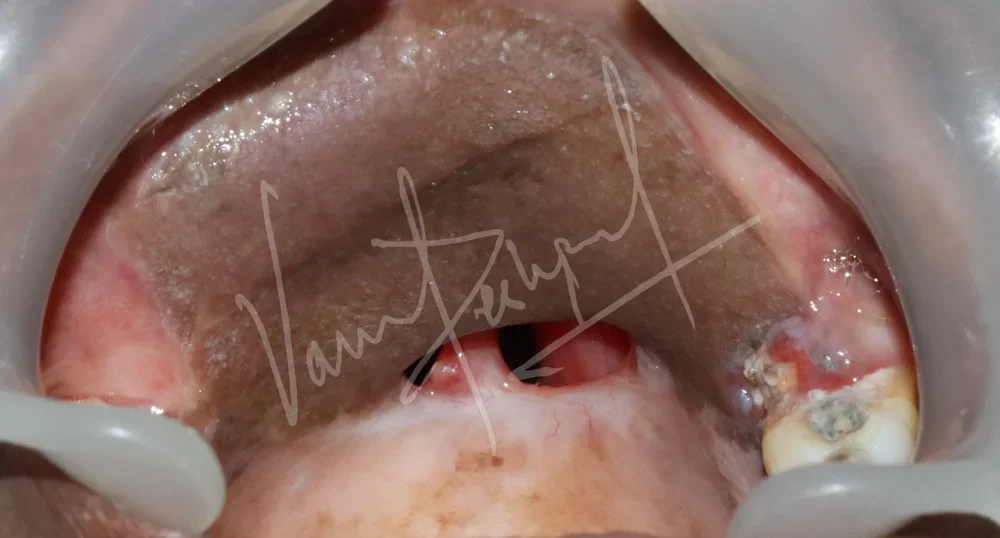 Prosthetic Rehabilitation of Maxillary defect using Obturator and Precision Attachment - Image 1