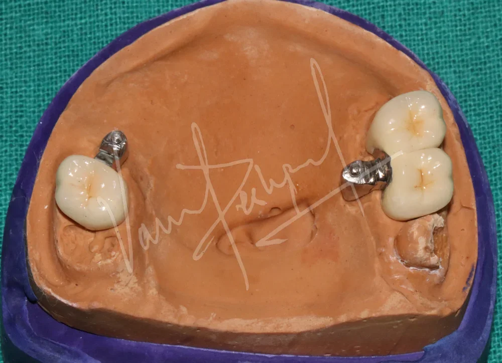 Prosthetic Rehabilitation of Maxillary defect using Obturator and Precision Attachment - Image 10