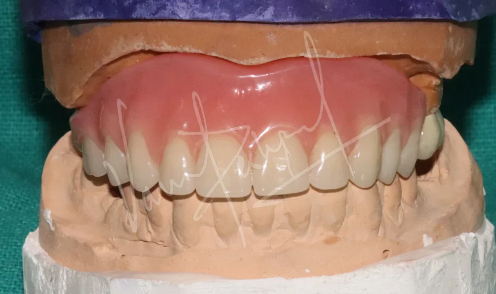 Complete & Partial Dentures