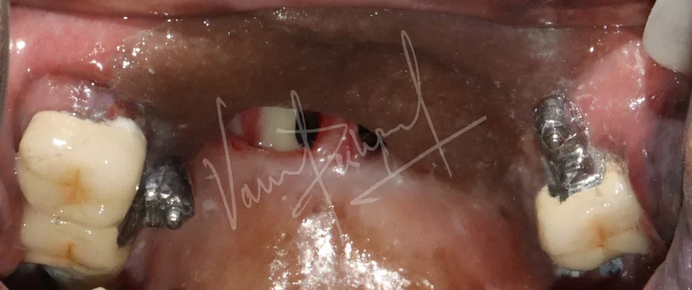 Prosthetic Rehabilitation of Maxillary defect using Obturator and Precision Attachment - Image 13