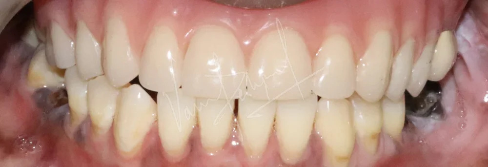 Prosthetic Rehabilitation of Maxillary defect using Obturator and Precision Attachment