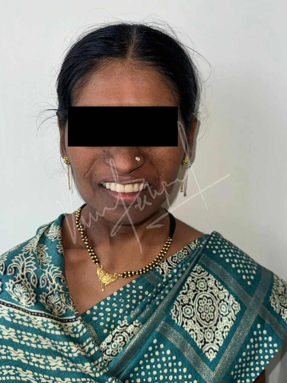 Prosthetic Rehabilitation of Maxillary defect using Obturator and Precision Attachment - Image 15