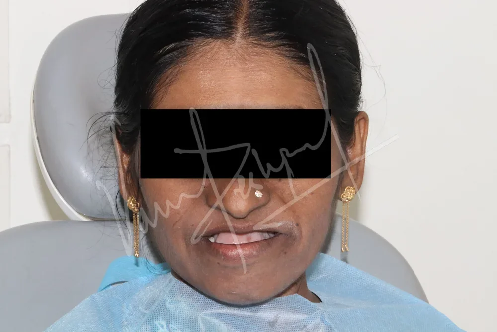 Prosthetic Rehabilitation of Maxillary defect using Obturator and Precision Attachment - Image 18