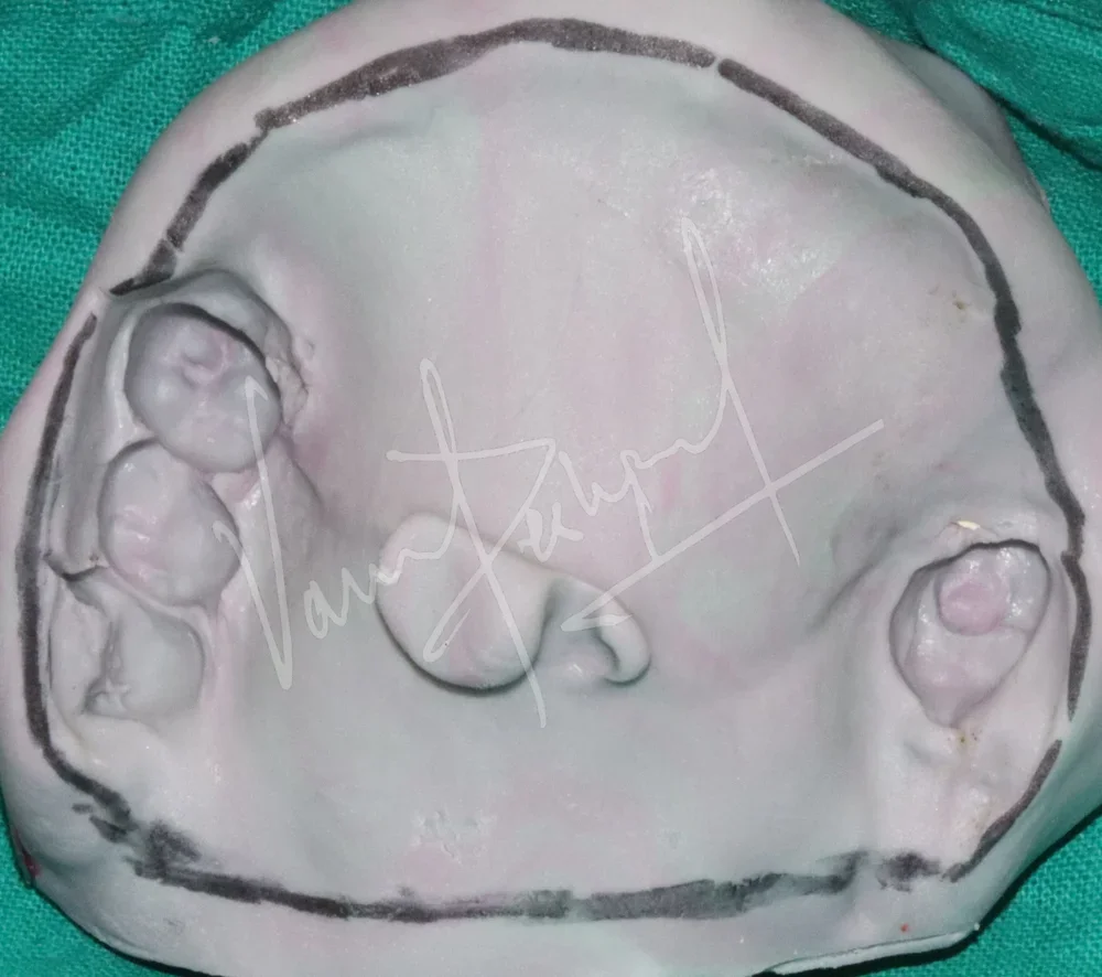 Prosthetic Rehabilitation of Maxillary defect using Obturator and Precision Attachment - Image 3