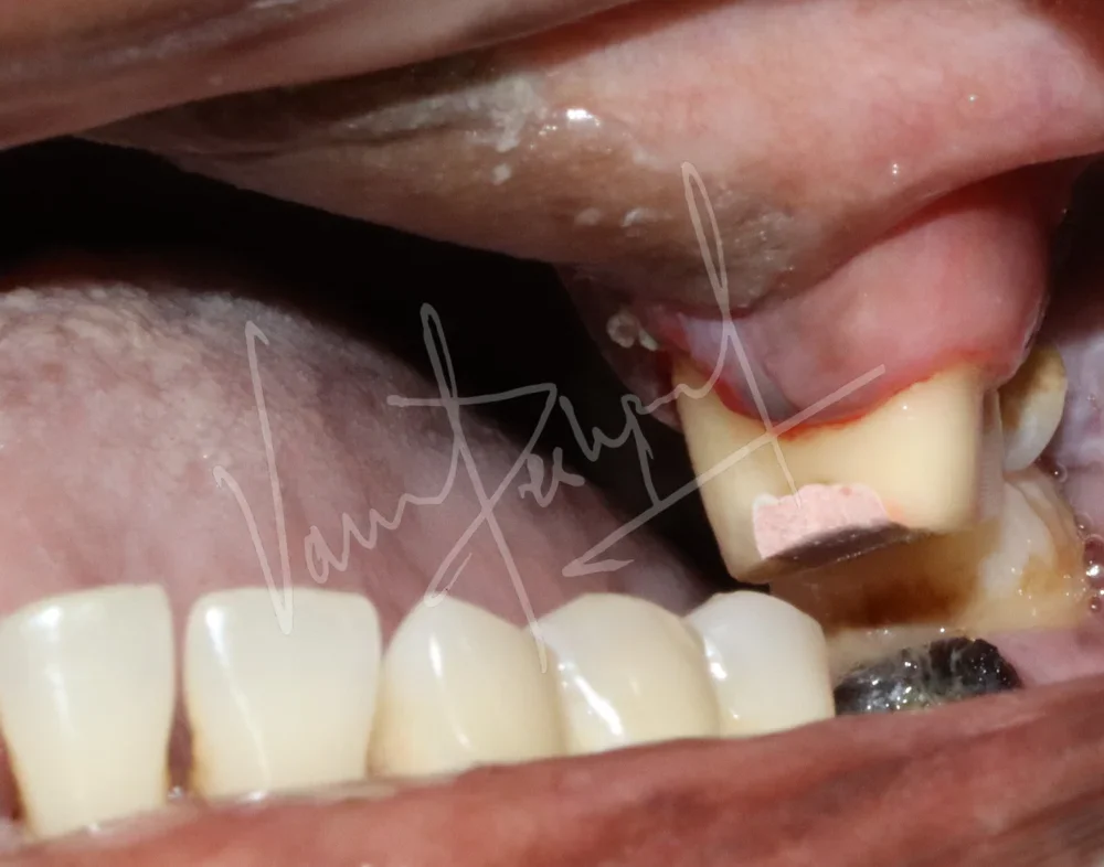 Prosthetic Rehabilitation of Maxillary defect using Obturator and Precision Attachment - Image 4