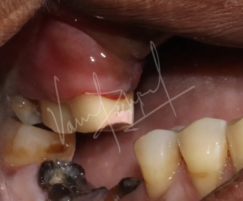 Prosthetic Rehabilitation of Maxillary defect using Obturator and Precision Attachment - Image 5