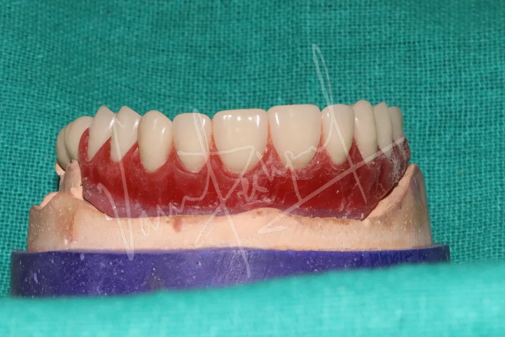 Prosthetic Rehabilitation of Maxillary defect using Obturator and Precision Attachment - Image 7
