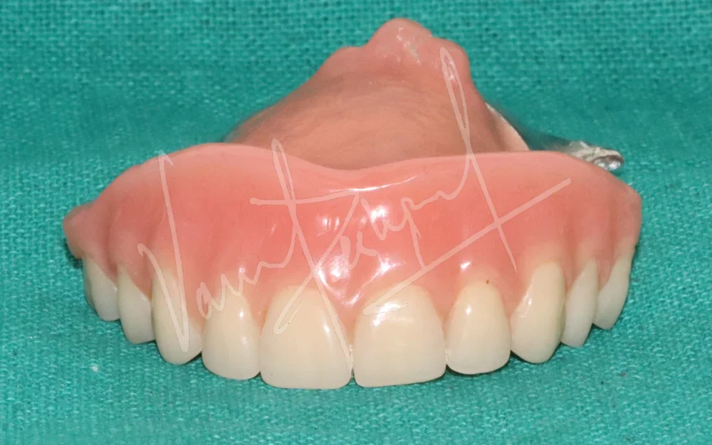 Prosthetic Rehabilitation of Maxillary defect using Obturator and Precision Attachment - Image 9