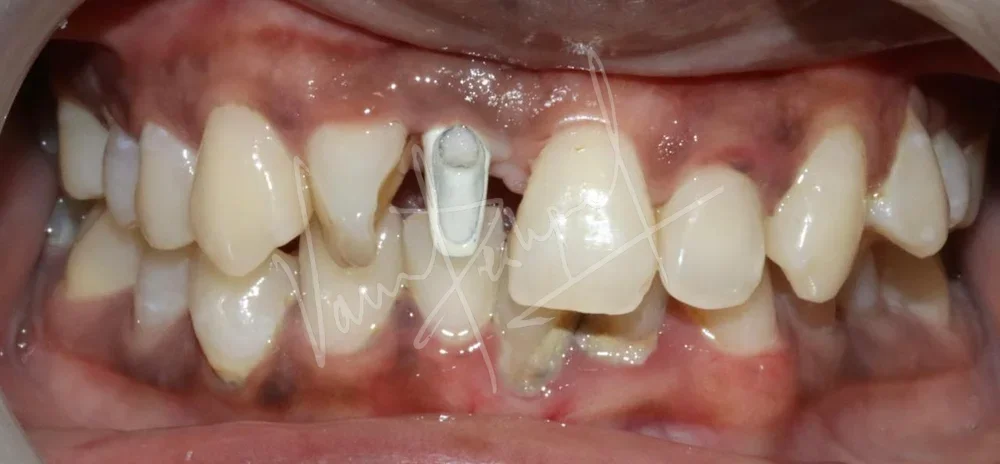 Replacing Anterior Single Tooth with Dental Implant - Image 2