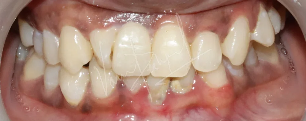 Replacing Anterior Single Tooth with Dental Implant - Image 3