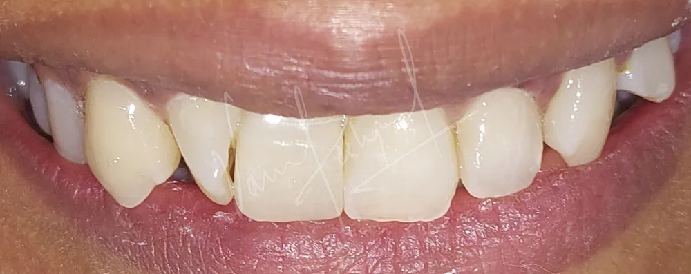 Replacing Anterior Single Tooth with Dental Implant