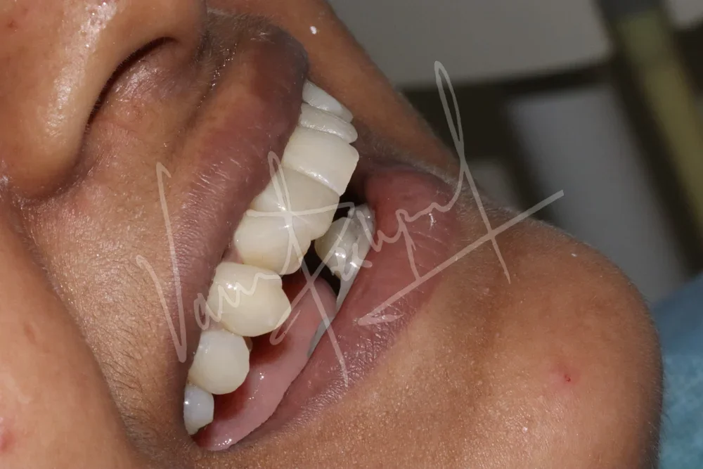 Replacing Anterior Single Tooth with Dental Implant - Image 5