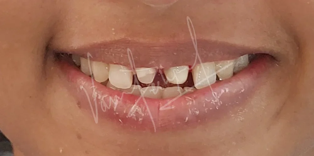 Restoring Anterior Fractured Teeth with All Ceramic Prosthesis - Image 2