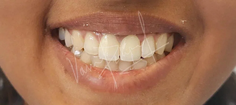 Restoring Anterior Fractured Teeth with All Ceramic Prosthesis - Image 3