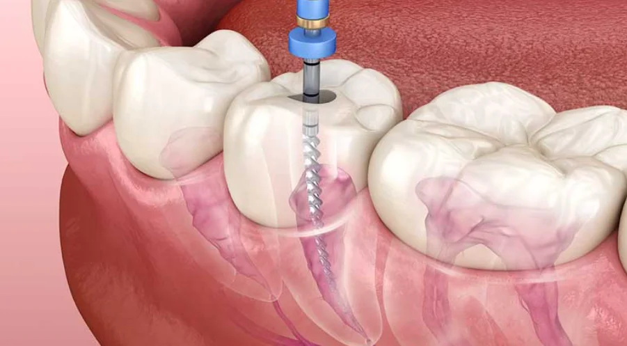 Root Canal Treatment