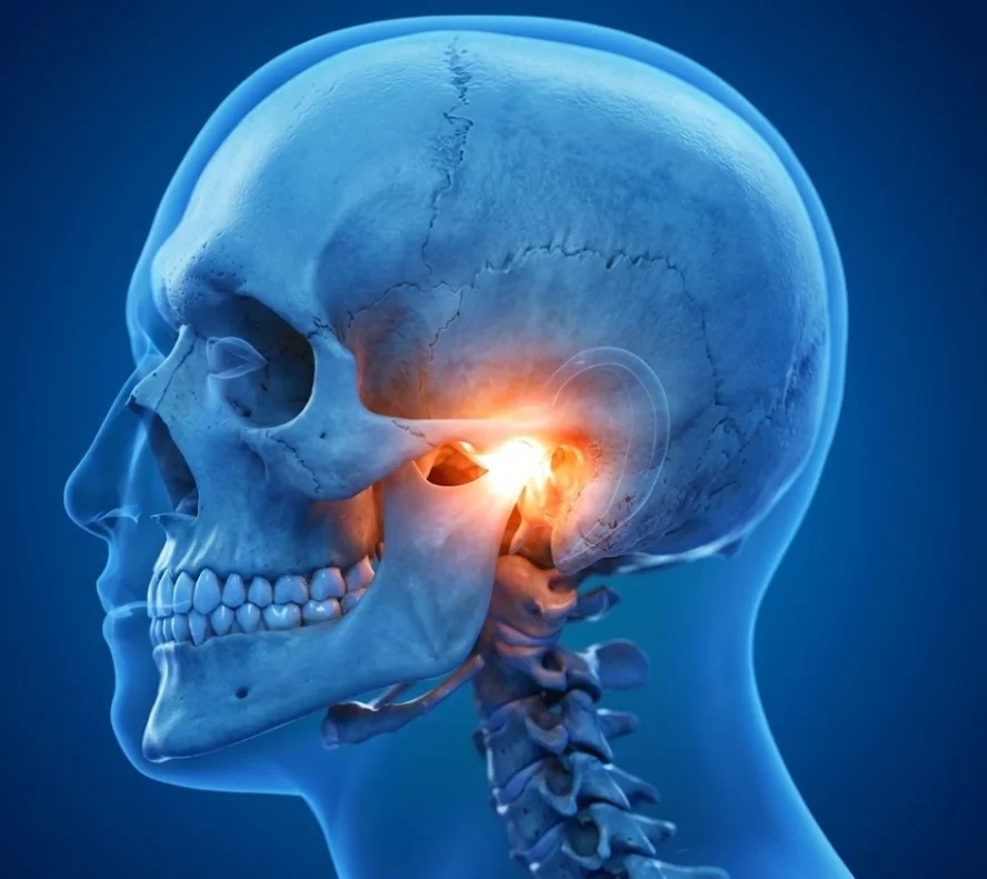 Diagram showing the Temporomandibular Joint (TMJ) anatomy and pain areas.