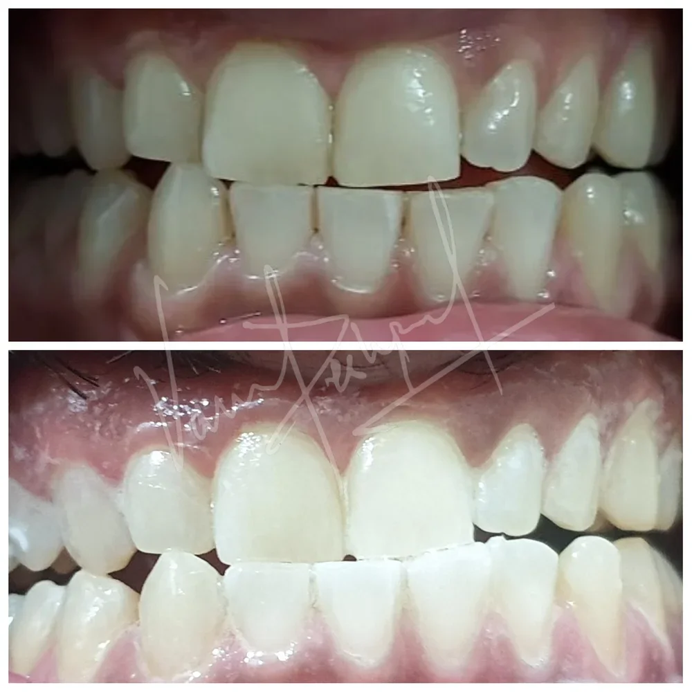 Zoom Teeth Whitening - Image 12